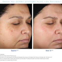 Enhanced Form Plastic Surgery M Vincent Makhlouf, MD, FACS - Improve fine lines, dark spots & uneven skin tone: http://www.enhancedform.com/2018/03/14/obagi-fine-lines-uneven-skin-tone/