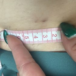 Christine Fisher MD, FACS - Scaring that I was told would be a "freckle" I have 8 of these