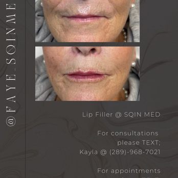 SQIN MED - Subtle lip filler, PDO Thread lift - Medical Spas Near Me - Niagara Falls, Ontario SQIN MED - Subtle lip filler, PDO Thread lift - Medical Spas Near Me - Niagara Falls, Ontario