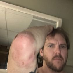 Injured elbow from being kidnapped from my home after calling 911 for HELP police from next town showed up and assaulted me and kidnapped me