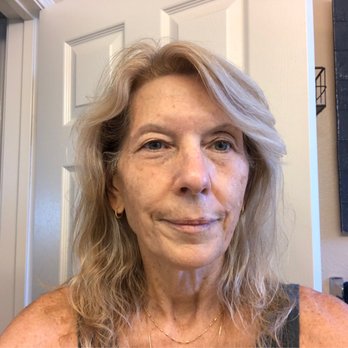 Love Med Spa - This was after the peels but before Botox and filler - Medical Spas Near Me - Oxnard, California