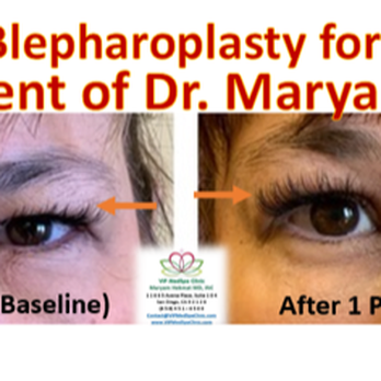 VIP MedSpa Clinic - Non-Surgical Blepharoplasty for Upper eyelid with Plexr Plasma - Medical Spas Near Me - San Diego, California VIP MedSpa Clinic - Non-Surgical Blepharoplasty for Upper eyelid with Plexr Plasma - Medical Spas Near Me - San Diego, California