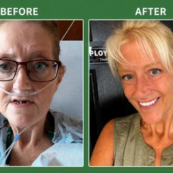 Greater Florida Dental Implants - My before GFDI and after GFDI