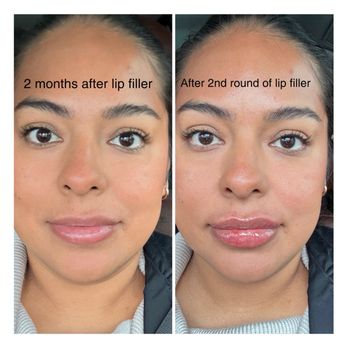 NakedMD - Anaheim location. Focused more on symmetry and fuller upper lip. - Medical Spas Near Me - Anaheim, California NakedMD - Anaheim location. Focused more on symmetry and fuller upper lip. - Medical Spas Near Me - Anaheim, California
