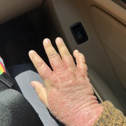 Natural Healing Center - Hand two weeks into seeing Joann so ashamed could barely move my hands or use my fingers