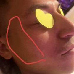 Pure Aromas Spa - Client face before , 10 days remove your face Freckles, sun spots, Invalid refund