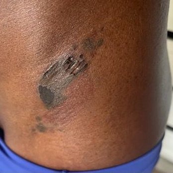 LaserAway - Few days after my tattoo was lasered - Tattoo Removal Near Me - Tualatin, Oregon LaserAway - Few days after my tattoo was lasered - Tattoo Removal Near Me - Tualatin, Oregon
