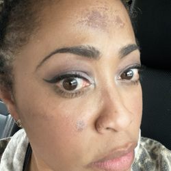 BioDerm Skincare & Laser Center - Chemical burns