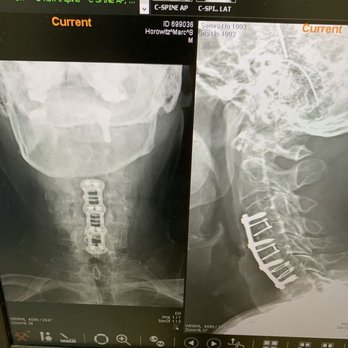 Florida Spine Associates - X-ray one year post post surgery for 3 level cervical spine decompression and fusion. Outstanding results! Surgeon Robert Norton - Spine Surgeons Near Me - Boca Raton, Florida