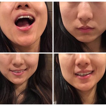 Sam Most, MD - Post Botox injection. I couldn't smile properly. It had been like this for more than half year and is really depressing - Cosmetic Surgeons Near Me - Stanford, California