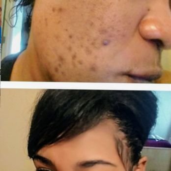Nouvelle Medical Aesthetics - VI Peel (Before and After 3 treatments) - Medical Spas Near Me - Davis, California Nouvelle Medical Aesthetics - VI Peel (Before and After 3 treatments) - Medical Spas Near Me - Davis, California