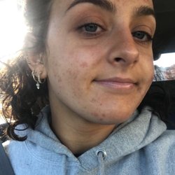 Fresh Faced Skin Care - Before