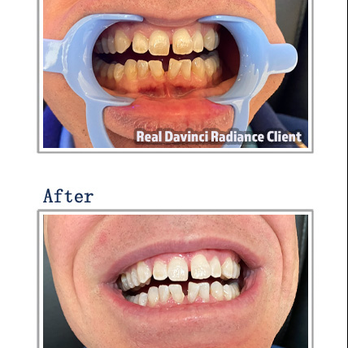 DaVinci Radiance - 1.) Apply whitening gel (upper & lower arch)
2.) Blue LED light activation
3.) Rinse & reveal a radiant smile - Teeth Whitening Near Me - Colorado Springs, Colorado DaVinci Radiance - 1.) Apply whitening gel (upper & lower arch)
2.) Blue LED light activation
3.) Rinse & reveal a radiant smile - Teeth Whitening Near Me - Colorado Springs, Colorado