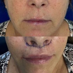 Samir S Undavia, MD - Liplift