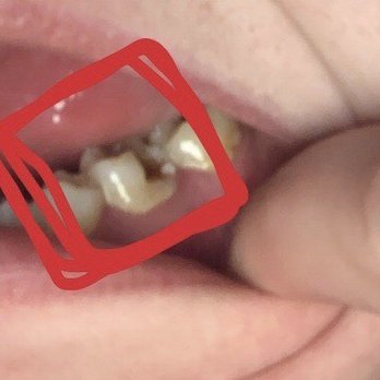 Jin Kim - Tooth before - General Dentistry Near Me - Sacramento, California Jin Kim - Tooth before - General Dentistry Near Me - Sacramento, California