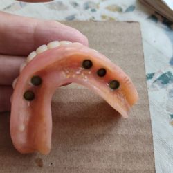 Albany County Dental Associates - This is the horrible over denture the was so nasty.