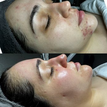 Skin By Britney - B & A - Skin Care Near Me - Cypress, California Skin By Britney - B & A - Skin Care Near Me - Cypress, California