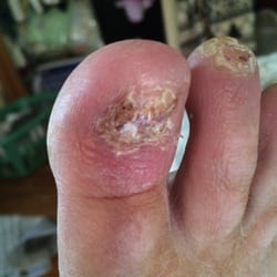 Valenza L Paul, DPM - This photo was taken two days ago as you can see my toe is in very bad shape in the possibility of losing it also my second toe.