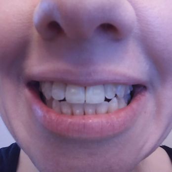 Pleasant Hill Orthodontics - I have completed 16 out of 23 trays so far and the gap in my bite is really closing!! - Orthodontists Near Me - Pleasant Hill, California Pleasant Hill Orthodontics - I have completed 16 out of 23 trays so far and the gap in my bite is really closing!! - Orthodontists Near Me - Pleasant Hill, California
