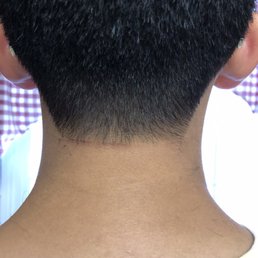 Dull trimmer left painful cut in back of neck Dull trimmer left painful cut in back of neck