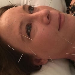 Sarah Norvilas, L.Ac - Better than Botox!