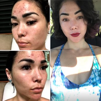 Complete Dermatology - 3-4 week BEFORE/AFTER photos. I noticed I difference in my skin immediately after using my prescribed creams - Dermatologists Near Me - Kapolei, Hawaii Complete Dermatology - 3-4 week BEFORE/AFTER photos. I noticed I difference in my skin immediately after using my prescribed creams - Dermatologists Near Me - Kapolei, Hawaii