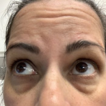 SSK Plastic Surgery - Before - Cosmetic Surgeons Near Me - Newport Beach, California