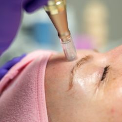 Soft Lux Skin - Nano needling! My most popular service in the treatment room.