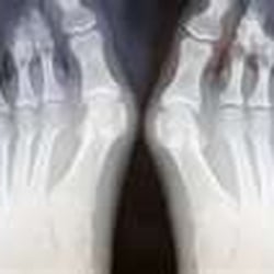 Russell Chiropractic Hand & Foot Clinic - Bunions