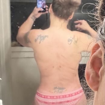 Orange County Cosmetic Surgery - Lipo of the back - Cosmetic Surgeons Near Me - Huntington Beach, California Orange County Cosmetic Surgery - Lipo of the back - Cosmetic Surgeons Near Me - Huntington Beach, California