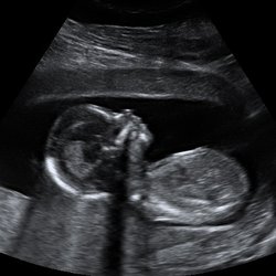 Amazing Baby 3D Ultrasound