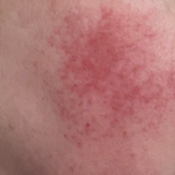 Massage Envy - Burned on the left side of my face by Savannah - Massage Near Me - Wildomar, California Massage Envy - Burned on the left side of my face by Savannah - Massage Near Me - Wildomar, California