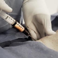 Tim Neavin - Plastic surgeon Santa Barbara - Fat harvesting, using gentle negative pressure with a 10 cc syringe.