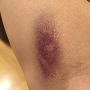 Quest Diagnostics - This is what my arm looks like at the end of day two. - Laboratory Testing Near Me - San Jose, California Quest Diagnostics - This is what my arm looks like at the end of day two. - Laboratory Testing Near Me - San Jose, California