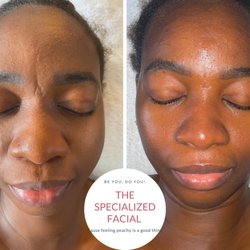 The Peach Bar - Anti-aging treatment with skin tightening. Benefits reduce fine lines and wrinkles, dark circles ,sagging skin.