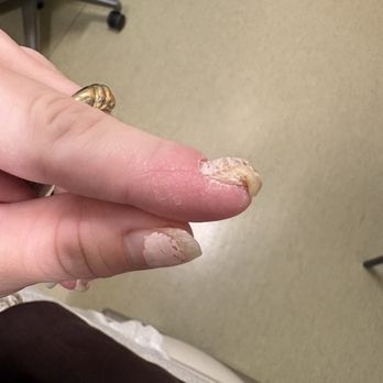 Weymouth Nails And Spa - My infected nail from dirty tools. - Nail Salons Near Me - North Weymouth, Massachusetts Weymouth Nails And Spa - My infected nail from dirty tools. - Nail Salons Near Me - North Weymouth, Massachusetts