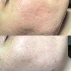 Jillian L Skin - Microneedling progress