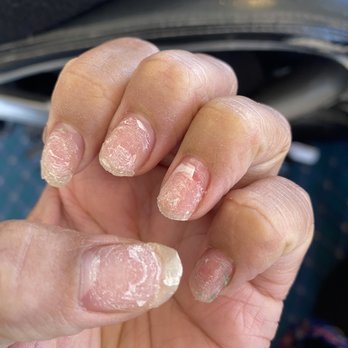 Y2K Nails - A closer look at the missing chunk of nail and injury to my nail bed - Nail Salons Near Me - Sacramento, California