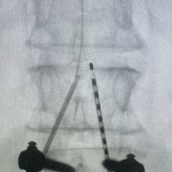 Ali Jaffer MD - Regenerative Pain Medicine - Spinal cord stimulator
