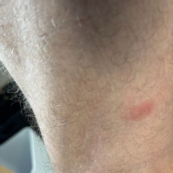 Classen Inn - Bedbug bites - Hotels Near Me - Oklahoma City, Oklahoma
