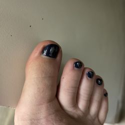 Ariel's Nails & Spa - Swollen big toe from being dug at
