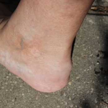 Charles M Miller, DPM - My huge bone spur with tears in Achilles Heel, very painful. - Podiatrists Near Me - Brooksville, Florida Charles M Miller, DPM - My huge bone spur with tears in Achilles Heel, very painful. - Podiatrists Near Me - Brooksville, Florida