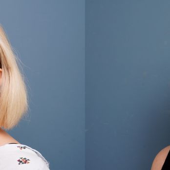 Landon Pryor, MD - 63 year old female before and 3 weeks after fat transfer to face - Cosmetic Surgeons Near Me - Boca Raton, Florida Landon Pryor, MD - 63 year old female before and 3 weeks after fat transfer to face - Cosmetic Surgeons Near Me - Boca Raton, Florida