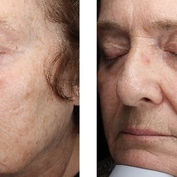 BBL before & after