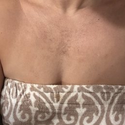 2nd treatment a few days later 2nd treatment a few days later