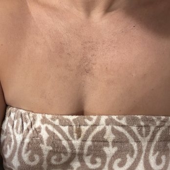 Evolve Skin Spa and Wellness - 2nd treatment a few days later - Skin Care Near Me - Carlsbad, California Evolve Skin Spa and Wellness - 2nd treatment a few days later - Skin Care Near Me - Carlsbad, California