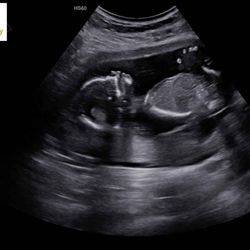 Picture Me Baby Ultrasounds - Baby L 15weeks Gender Ultrasound