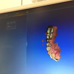 Advancia Dental - Cad of your teeth for precise fitting!