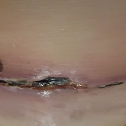 Vixen Plastic Surgery - Botched tummy tuck