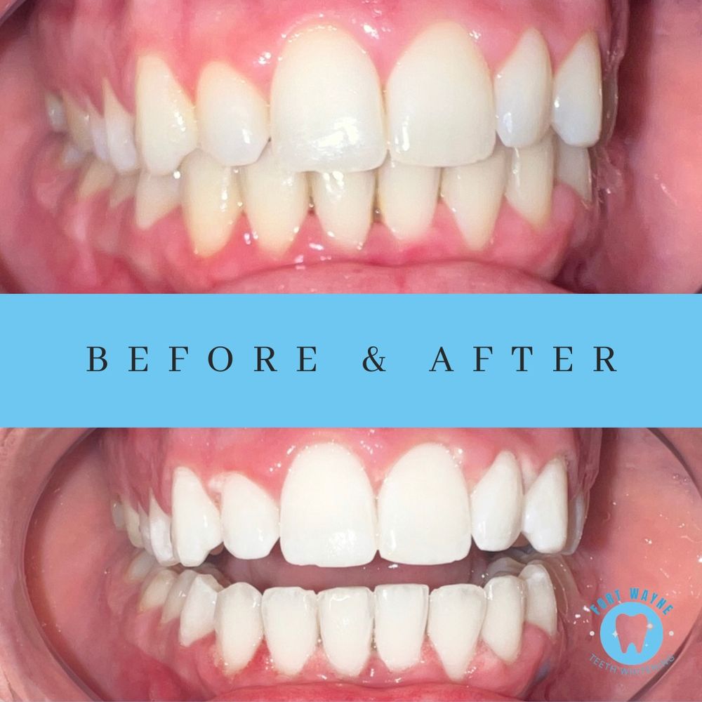 FORT WAYNE TEETH WHITENING 3468 Stellhorn Rd, Fort Wayne, Indiana Teeth Whitening Phone